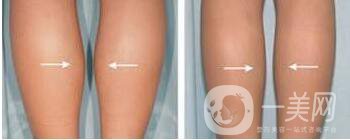 神經(jīng)瘦小腿,危害,后遺癥