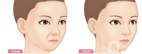 重慶,自體脂肪豐鼻唇溝,優(yōu)勢(shì)