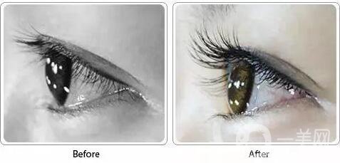 北京做睫毛移植術(shù)一般多少錢