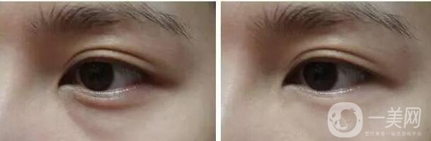 成都,超聲去眼袋,注意事項(xiàng)