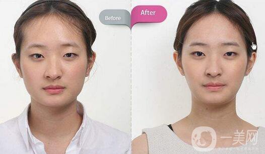 磨骨多少錢？磨骨價格盤點(diǎn)！