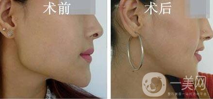 磨骨多少錢？磨骨價格盤點(diǎn)！