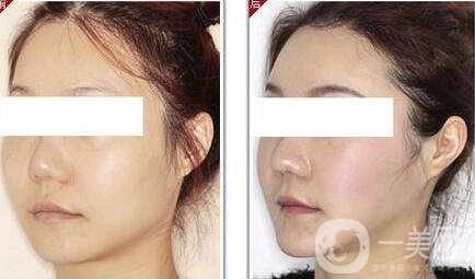 改臉型需要多少錢？