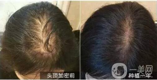 北京做植發(fā)手術哪里*果好？