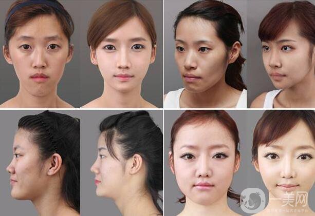 北京顴骨手術(shù)要多少錢？