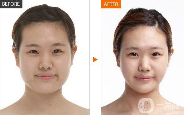 北京顴骨手術(shù)要多少錢？