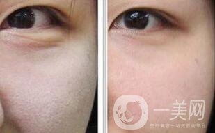 光子嫩膚介紹?成都光子嫩膚醫(yī)院介紹