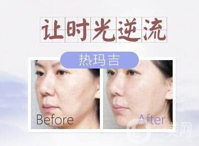 塑美極的副作用有哪些？