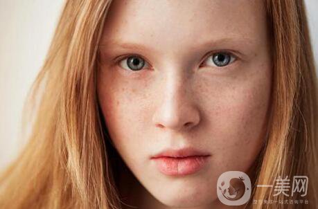 黃褐斑能用激光去除嗎？