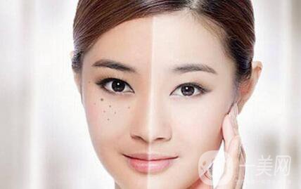 黃褐斑能用激光去除嗎？