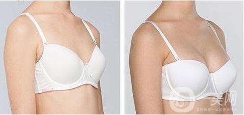 杭州,妙桃假體,隆胸,缺點(diǎn)