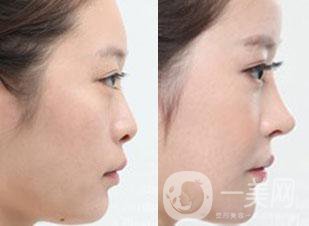 廣東*整形手術(shù)一般要多少錢