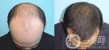 鄭州植發(fā)醫(yī)院信息介紹？植發(fā)去介紹