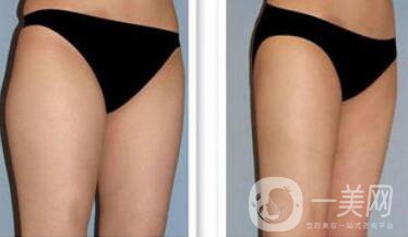 吸脂*嗎？吸脂手術(shù)有風(fēng)險(xiǎn)嗎