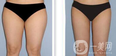 吸脂*嗎？吸脂手術(shù)有風(fēng)險(xiǎn)嗎