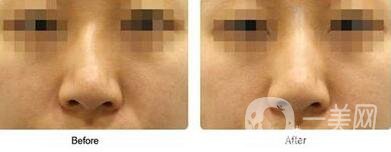 歪鼻矯正需要恢復(fù)多久？術(shù)后需要注意什么