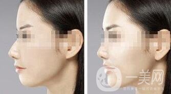 墊下巴用什么材料好？墊下巴改良臉型*果