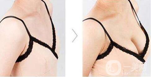 廣東,隆胸,價(jià)格