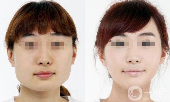 面部吸脂,去頰脂墊,面部吸脂和去頰脂墊信息介紹