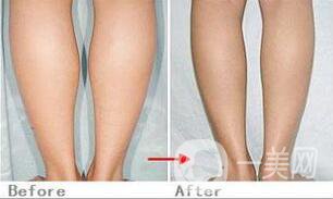 瘦小腿手術(shù)是怎么樣的，具體方法有哪些