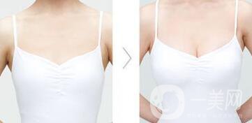 豐胸要注意什么?豐滿身材的秘密