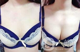 隆胸恢復(fù)期多長時間 性感身材輕松擁有