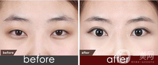 開眼角整形手術(shù)之后日常生活要注意什么