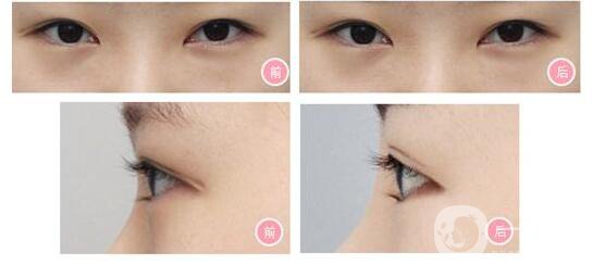 成都開(kāi)內(nèi)外眼角,開(kāi)內(nèi)外眼角多少錢,開(kāi)眼角價(jià)格