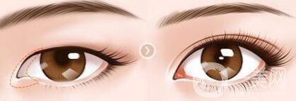 開眼角幾天恢復(fù)？開眼角手術(shù)費(fèi)用介紹