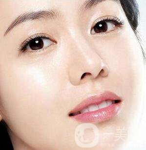 開內(nèi)眼角多久恢復(fù)自然？