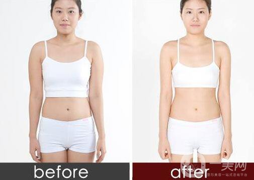 腰腹吸脂,腰腹吸脂多久消腫,腰腹吸脂術(shù)后護(hù)理方式