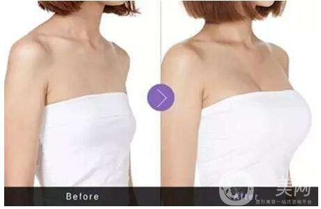 隆胸手術選擇自體隆胸好還是假體好 2