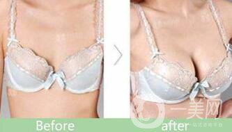 硅膠隆胸能管多久？隆胸手術(shù)具體費用