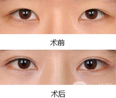 雙眼皮增生了怎么處理？雙眼皮修復(fù)價(jià)格多少