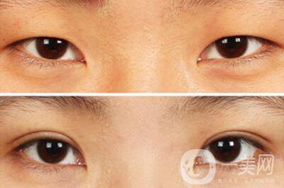 雙眼皮增生了怎么處理？雙眼皮修復(fù)價(jià)格多少