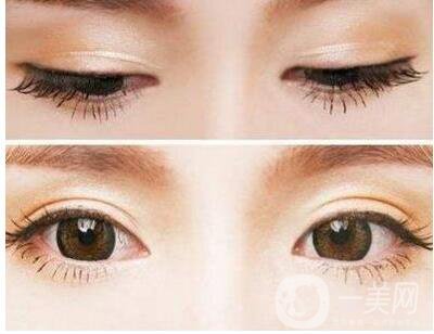 割雙眼皮,割雙眼皮恢復時間