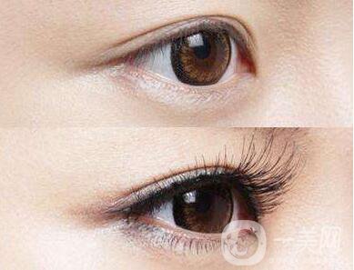 睫毛移植,睫毛移植后遺癥