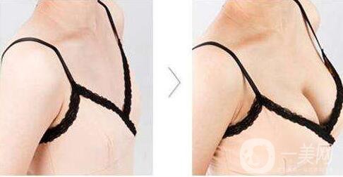 隆胸,隆胸術(shù)后護(hù)理