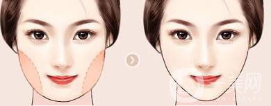 面部吸脂術(shù)后護(hù)理怎么做