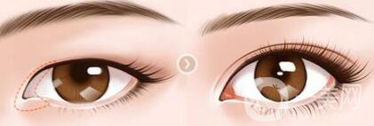 開眼角術(shù)后注意事項(xiàng)具體有哪些