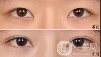 全切雙眼皮怎么護理 漂亮雙眼的秘密