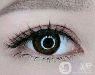 雙眼皮埋線前注意什么？