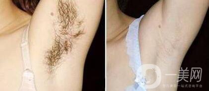 做過激光脫毛后如何護(hù)理