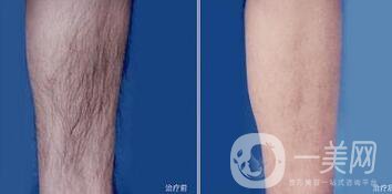 做過激光脫毛后如何護(hù)理