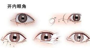 北京做開(kāi)眼角手術(shù)多少錢