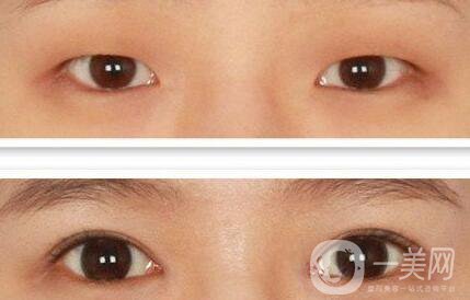 北京做開(kāi)眼角手術(shù)多少錢