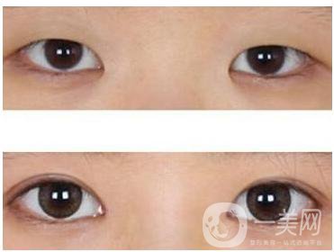 開眼角手術(shù)之后會(huì)疤痕增生嗎