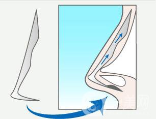 硅膠隆鼻整形之后為什么會感染