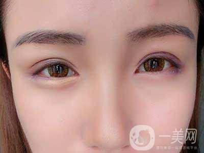 全切雙眼皮手術(shù)疼嗎