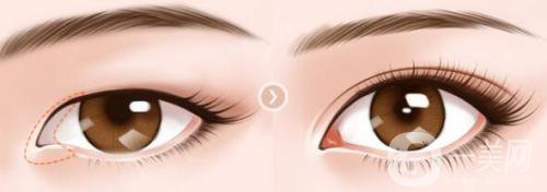 開眼角會(huì)疤痕增生嗎 術(shù)后應(yīng)該怎么護(hù)理